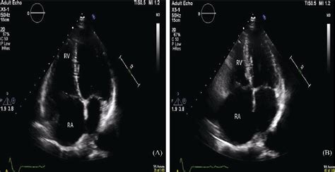 Figure 1 From Superior Sinus Venosus Atrial Septal Defect Semantic