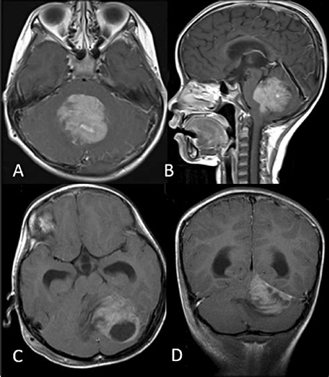 Axial A And Sagittal B T1 Weighted Gadolinium Enhanced Mri Showing