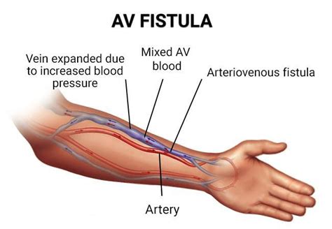 Percutaneous Av Fistula Creation Success Interventional Radiology