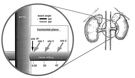 Renal Artery