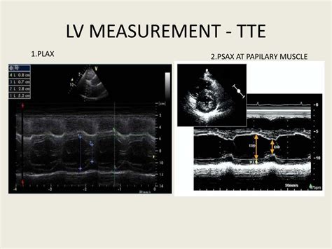 Lv Mass Measurement D Echo Literacy Basics