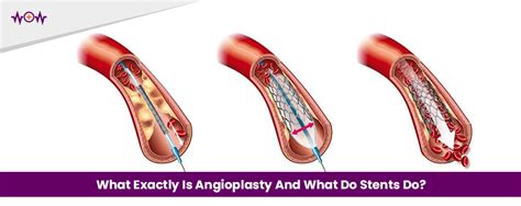 What Exactly Is Angioplasty And What Do Stents Do Wow Health