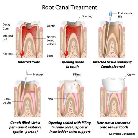 What happens when you undergo a root canal treatment? – Smiles of Naperville