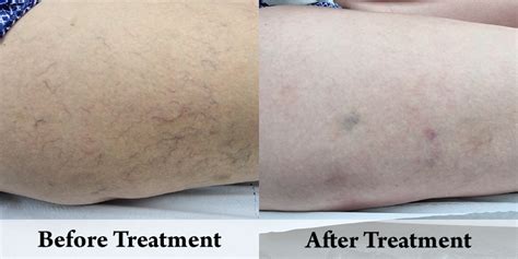 Vascular Lesions Thread Vein Treatments Panakeia Uk Panakeia