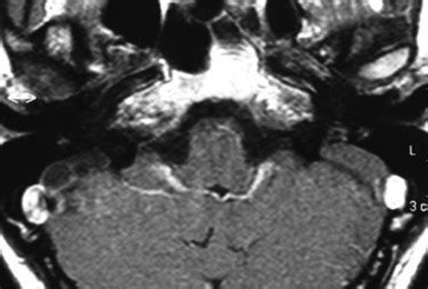 Bilaterally enlarged vestibular aqueduct - temporal bone MRI - axial ...