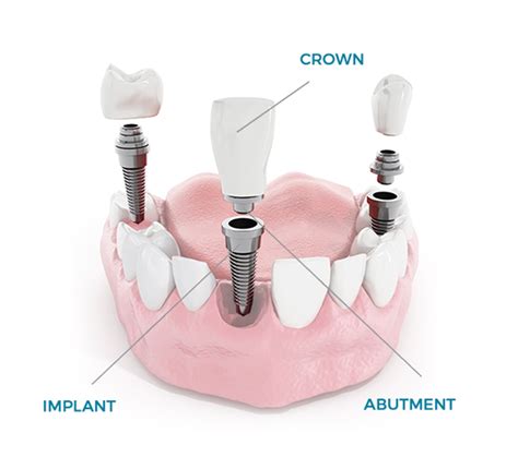 Dental Implants Implantology Aestetich Dentistry Dr Koran