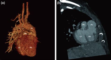 Preoperative Chest Computed Tomography With A Dimensional