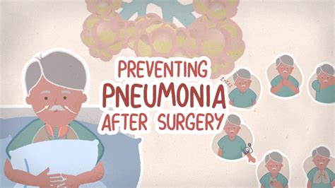 How To Prevent Pneumonia After Surgery Information For Patients Tvasurg Youtube