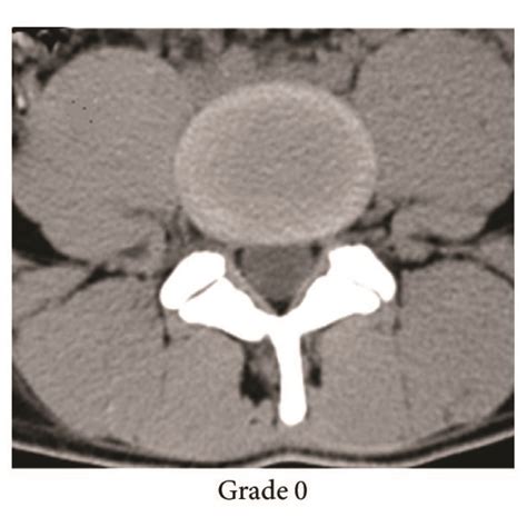 An Example Of Different Fatty Infiltration Grades In Lumbar Paraspinal