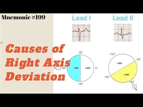 Right Axis Deviation Ecg - Simple Education / The mean qrs axis during ...