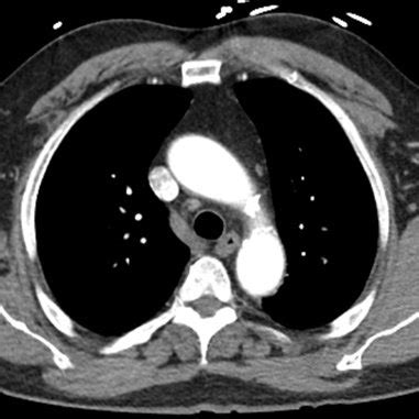 CT chest-mild left axillary adenopathy. | Download Scientific Diagram