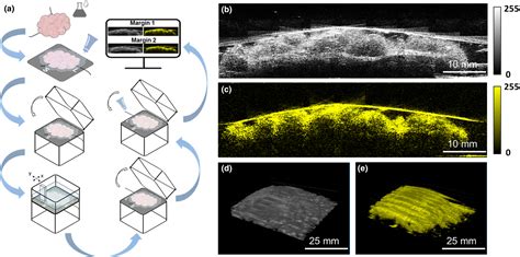 Highspeed Intraoperative Assessment Of Breast Tumour Margins By