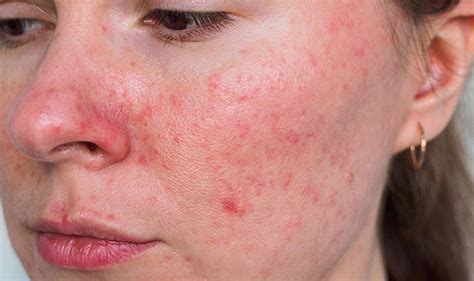 Rosacea Symptoms Causes Triggers And Treatment