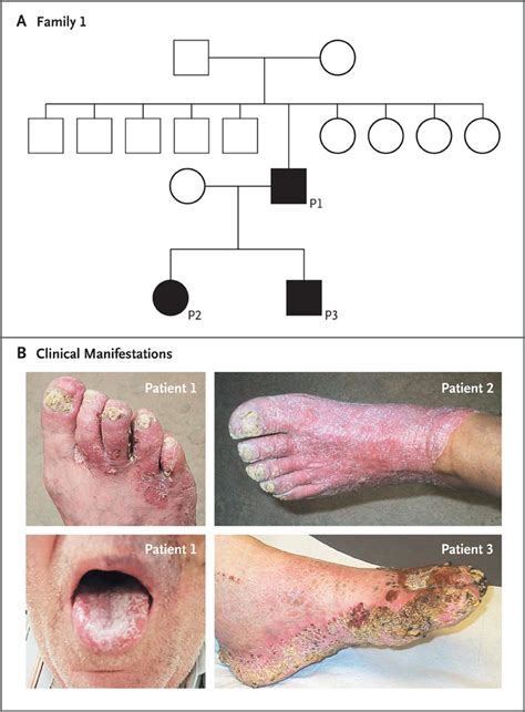 Mucocutaneous Candidiasis