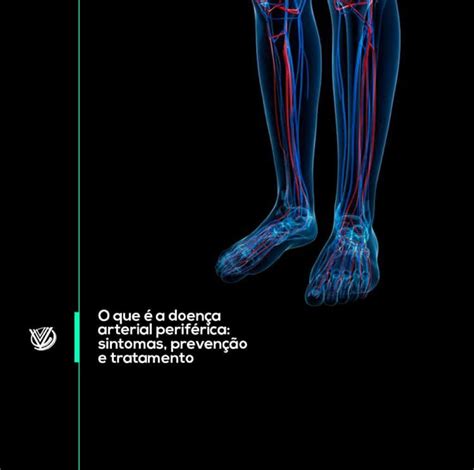 Doença Arterial Obstrutiva Periférica O Que é Insights E Informações