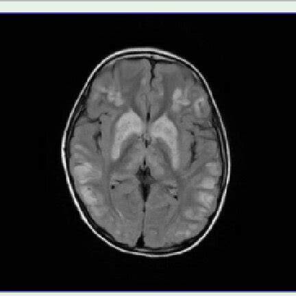 Brain MRI showing diffuse white matter abnormal signal in a patient ...