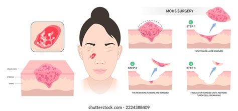 Facial Mohs Surgery Basal Cell Microscopic Stock Vector (Royalty Free ...