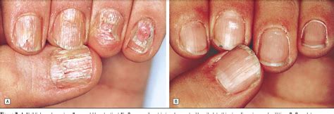 Figure 2 From Nail Lichen Planus In Children Clinical Features