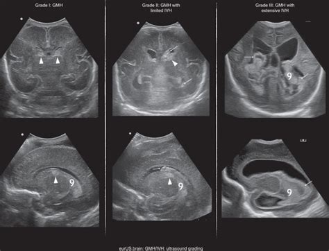 Cranial Ultrasound Findings In Preterm Germinal Matrix Haemorrhage