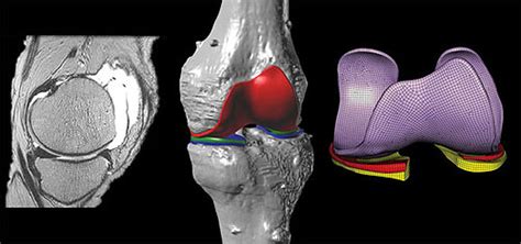 Realistic Simulation Probes Biomechanics Of Knees