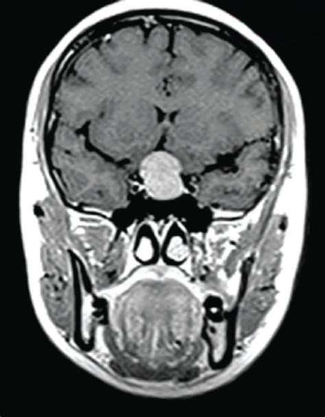 MRI finding of pituitary tumors. | Download Scientific Diagram