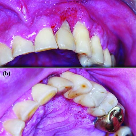 A Erythematous And Irregular Ulcer With Granular Surface Located In Download Scientific