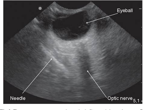 Figure 2 From Real Time Visualization Of Ultrasound Guided Retrobulbar Blockade An Imaging