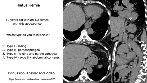 Case 82 Diagnosing Hiatus Hernia And Its Different Types