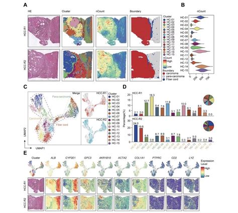 Overall Landscapes Of Spatial Transcriptomics In Hepatocellular