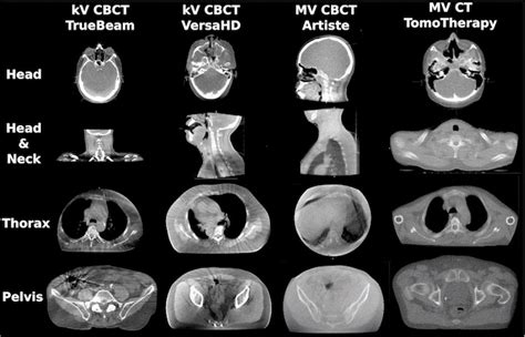 Assessment Of Image Quality And Dose Calculation Accuracy On Kv Cbct