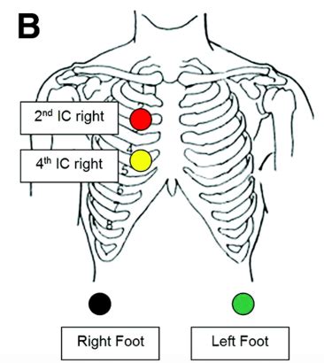 emDOCs.net – Emergency Medicine EducationECG Pointers – The Lewis Lead - emDOCs.net - Emergency ...