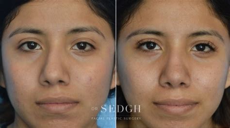 Crooked Nose Surgery Before After Photos Dr Sedgh