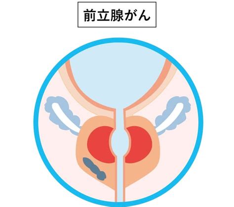 前立腺がん｜原因と特徴について がんの治療法 詳しく知りたい！