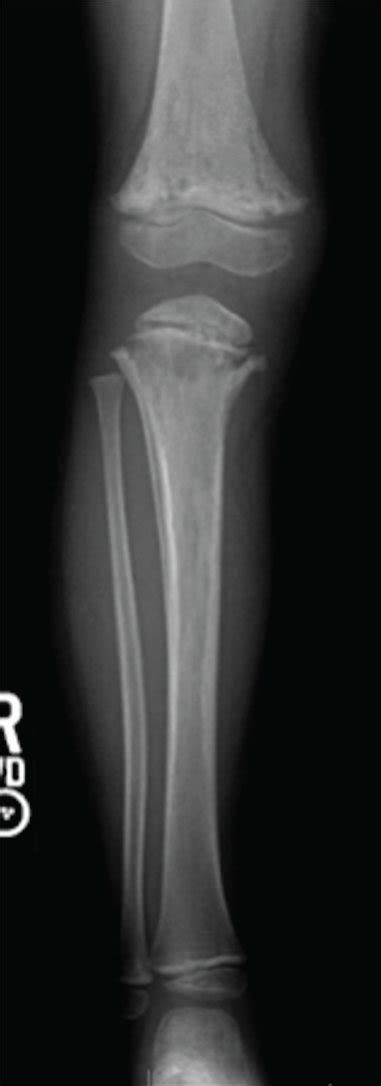 Anteroposterior A And Lateral B Plain Radiographs Of The Patient