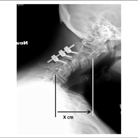 A Clinical Photograph Showing The Chin Brow Vertical Angle Cbva