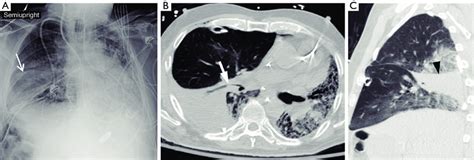 Post Operative Ap Chest Radiograph A In A Patient Who Underwent Right