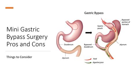 Mini Gastric Bypass Surgery Pros And Cons Things To Consider Youtube