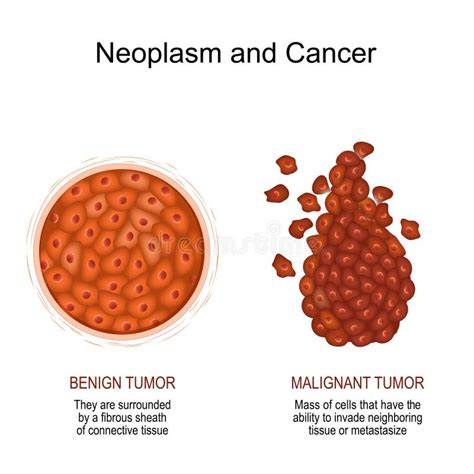 Neoplasia E Câncer Tumor Maligno E Benigno Ilustração Do Vetor