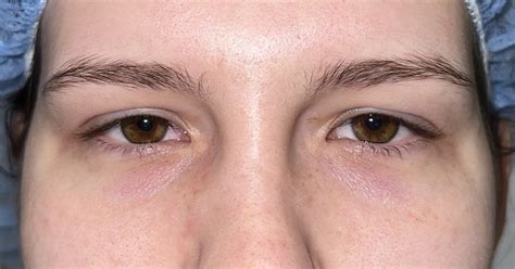 11 Upper Eyelid Surgery Before And After Photos Dallas Plano Texas Cosmetic Reconstructive