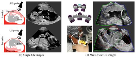 A Examples Of Anterior Top And Posterior Bottom Placentas In Download Scientific Diagram