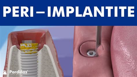 Peri implantite infecção de implante dentário YouTube