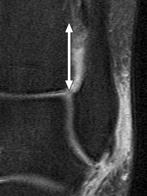 Lateral Ankle Ligaments Mri