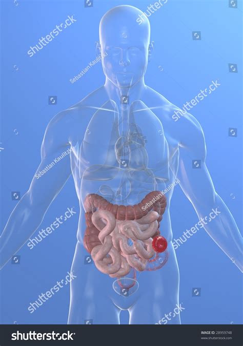 Colostomy Stock Illustration 28959748 | Shutterstock