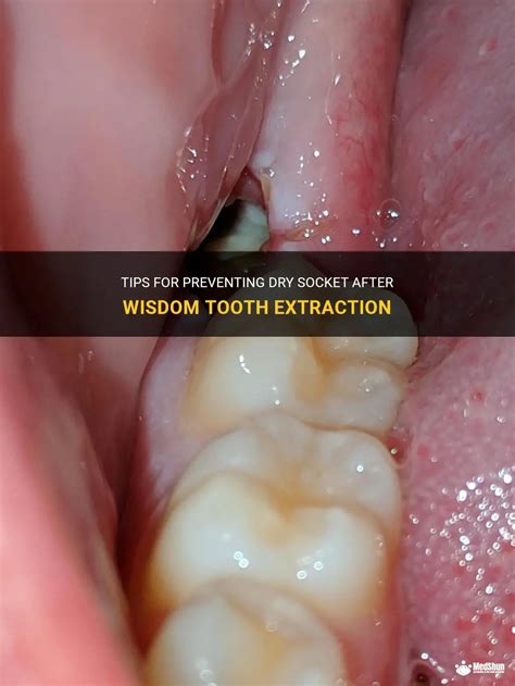 Tips For Preventing Dry Socket After Wisdom Tooth Extraction Medshun