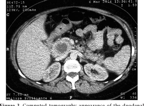 Figure 1 From A Duodenal Gastrointestinal Stromal Tumor With A Large Central Area Of Fluid And