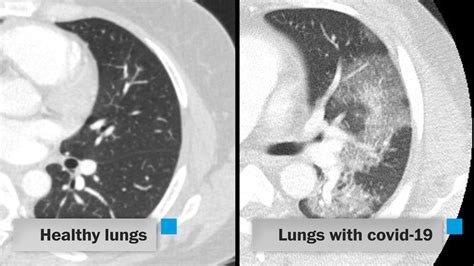 Explaining ARDS and how covid-19 attacks the lungs [Video]