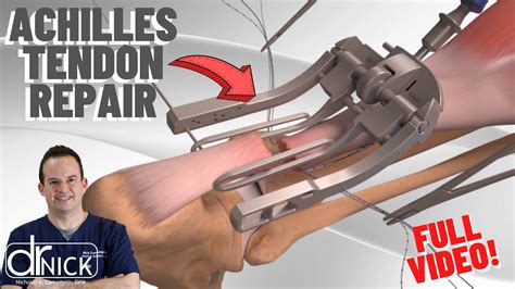 Achilles Tendon Rupture Repair With Arthrex Pars Dr Nick Campitelli