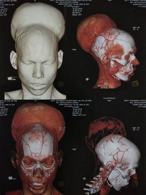 Doctors successfully remove ‘world’s largest brain tumor’