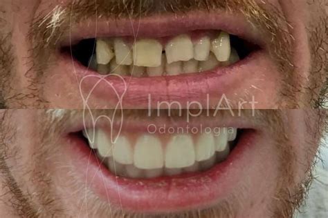 reabilitacao oral completa 50kb Implantes Dentários e Estética Dental