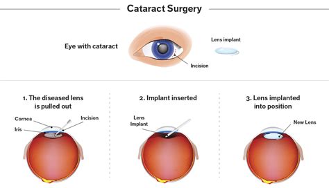 What Are Cataracts Understanding Symptoms And Treatment